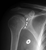 Anchor screws